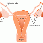 Endometriosis is a medical condition in women in which endometrial cells are deposited in areas outside the uterine cavity