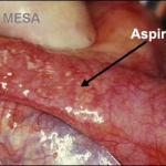 Microsurgical Epididymal Sperm Aspiration – MESA